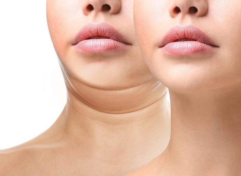 Độn cằm lẹm - cách khắc phục chiếc cằm bị lẹm hiệu quả4