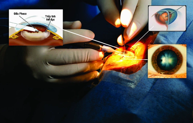 Đục thủy tinh thể có nên mổ không? 3