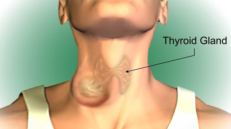 Đừng chủ quan khi có những triệu chứng bướu cổ đơn thuần này 2