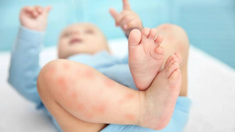 Lang ben là bệnh da liễu có thể gặp ở cả trẻ sơ sinh và người lớn