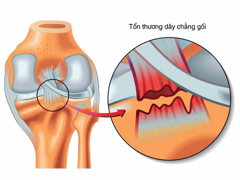 Đa phần các chấn thương đứt dây chằng chéo sau thường khó phát hiện và chẩn đoán chính xác