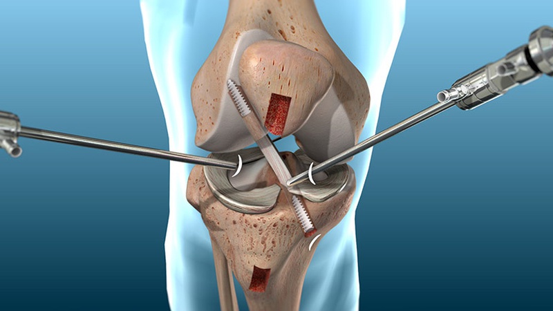 Những trường hợp nghiêm trọng hoặc tổn thương kèm với những chấn thương khác trong cấu trúc khớp gối thì sẽ được chỉ định phẫu thuật