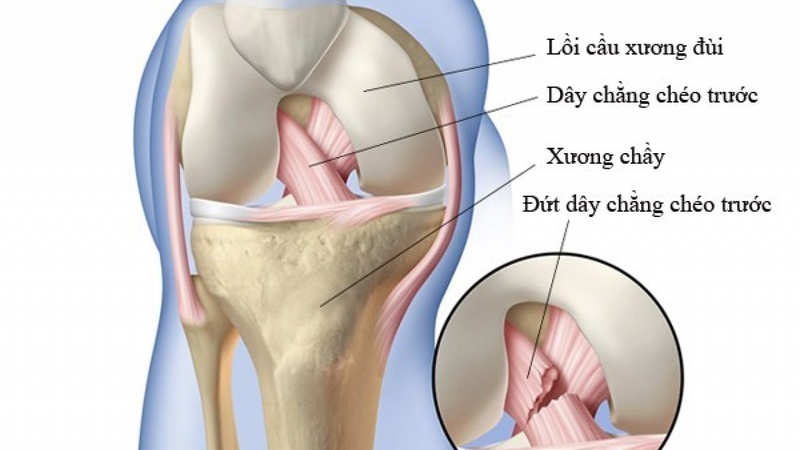 Dây chằng chéo trước là một trong những dây chằng chính ở đầu gối