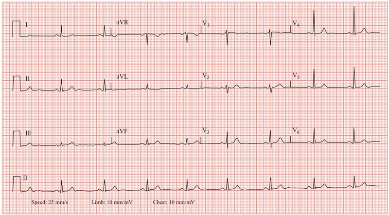 ECG trong thuyên tắc phổi có vai trò quan trọng trong chẩn đoán phát hiện hay loại trừ thuyên tắc