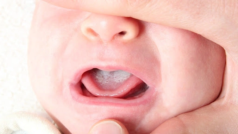 Dùng gạc rơ lưỡi giúp phòng ngừa các bệnh về răng miệng cho trẻ