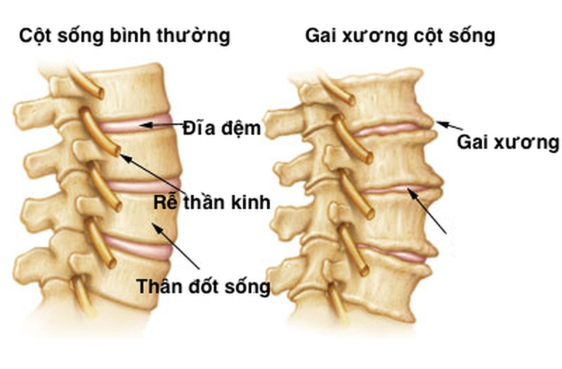 Giải đáp câu hỏi: Bệnh gai cột sống lưng có nguy hiểm không? 2