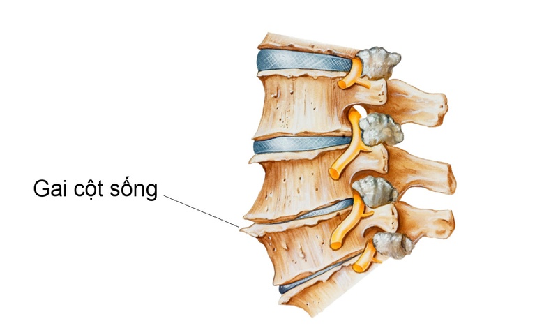 Gai cột sống triệu chứng không phải ai cũng biết