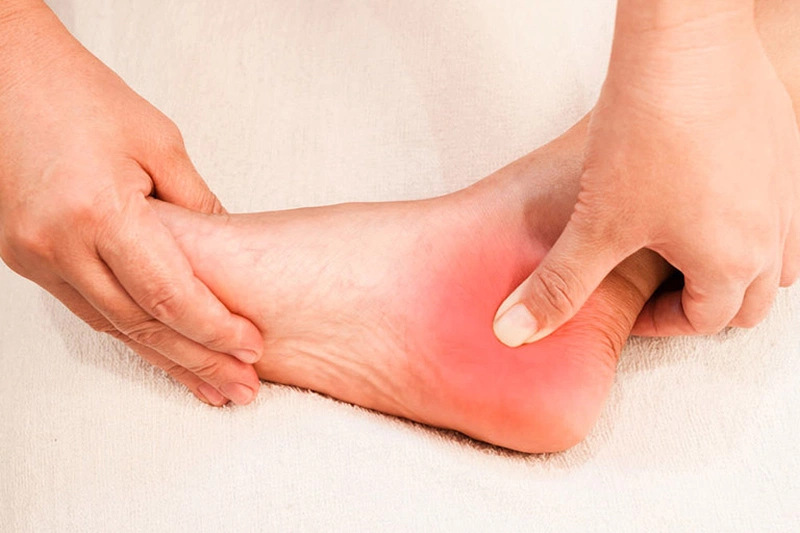 Gai gót chân kiêng ăn gì để mau khỏi bệnh? 1