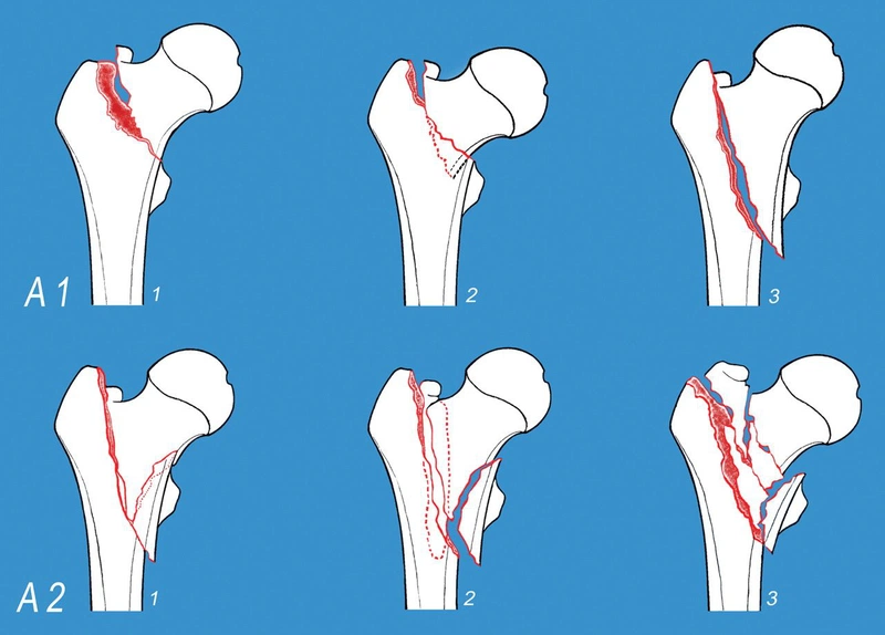 Tổng quan về tình trạng gãy liên mấu chuyển xương đùi 4