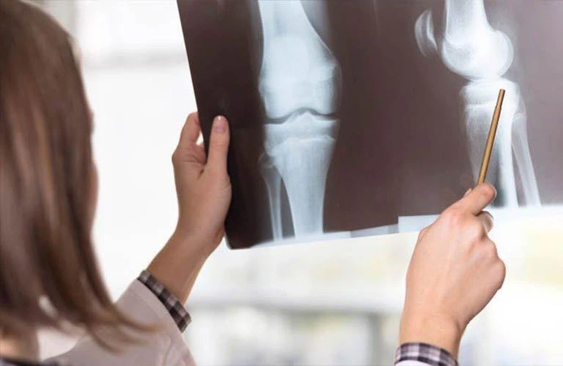 Gãy trên lồi cầu xương cánh tay là gì Triệu chứng và chẩn đoán 3