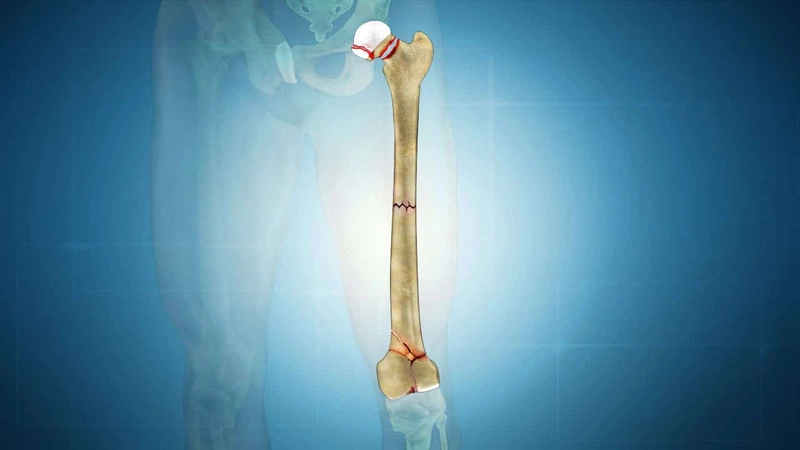 Gãy xương đùi bao lâu thì lành Lưu ý khi điều trị gãy xương đùi 1