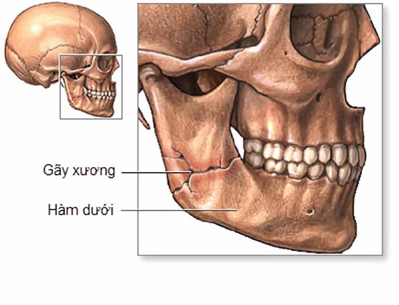 Gãy xương hàm dưới và phương pháp chăm sóc bệnh nhân đúng cách 1