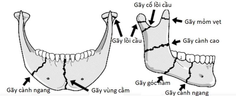 Gãy xương hàm dưới và phương pháp chăm sóc bệnh nhân đúng cách 2
