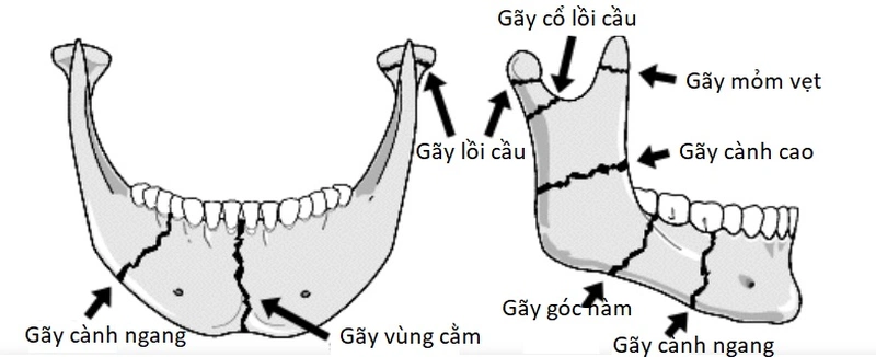 Giải đáp: gãy xương hàm dưới bao lâu thì lành 3