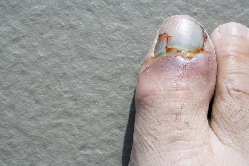 Gãy xương ngón chân Nguyên nhân và triệu chứng 2