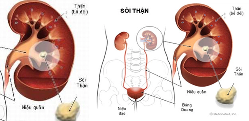 Giá siêu âm sỏi thận hết bao nhiêu?