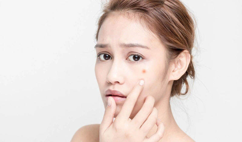 Giải cứu làn da với phương pháp trị mụn bằng sữa mẹ 1