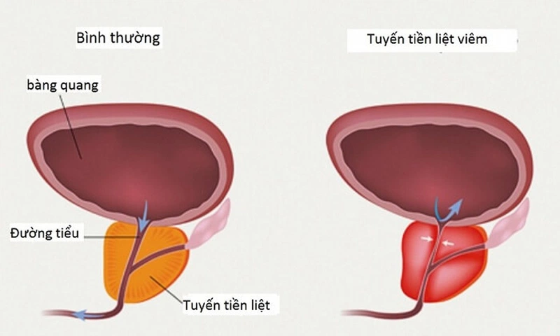 Giải đáp: Bị viêm tuyến tiền liệt có quan hệ được không 1