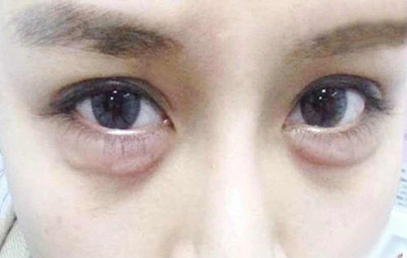Giải đáp: Bọng mắt có hạt là bệnh gì 1