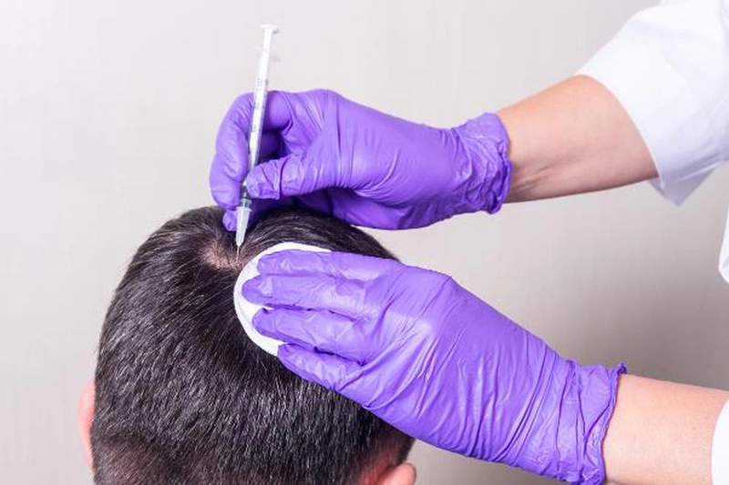 Trên thế giới hiện nay, cấy tóc đang trở thành lựa chọn hàng đầu của các chuyên gia để điều trị và giải quyết vấn đề hói đầu, rụng tóc ở nam và nữ