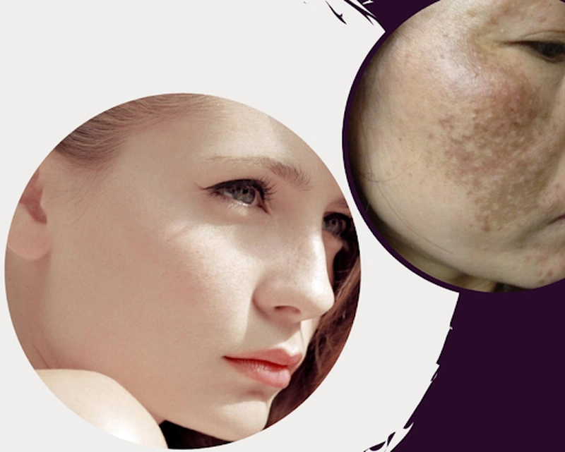 [Giải đáp] Chấm tàn nhang trên gò má có gây hại cho da hay không? 2