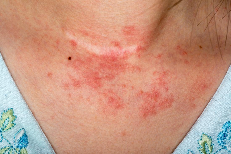 Giải đáp: Dị ứng da có bị lây không? 1