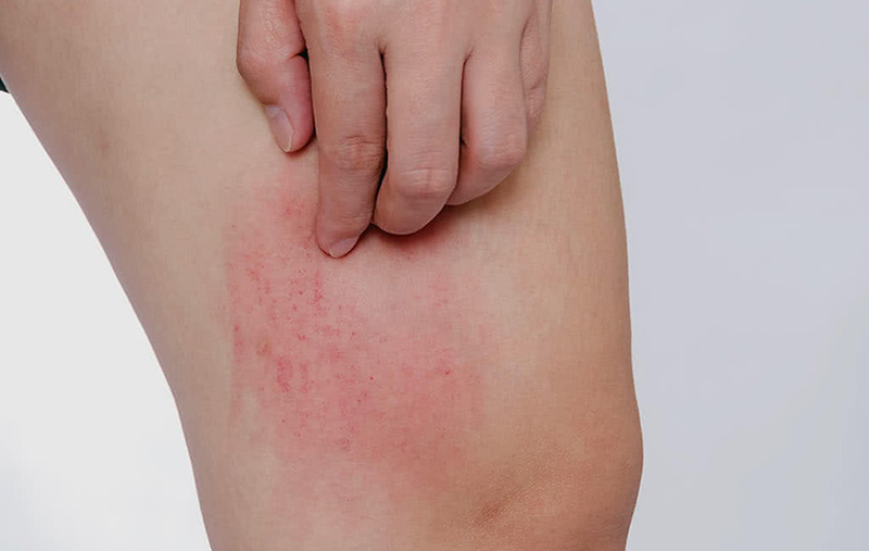 Giải đáp: Dị ứng da có bị lây không? 3