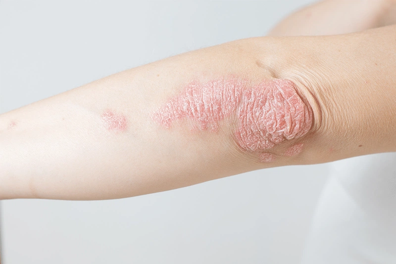 Giải đáp thắc mắc: Bệnh vảy nến á sừng có lây không?