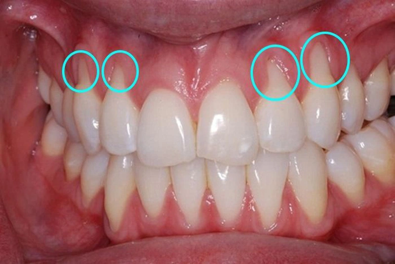 Tình trạng tụt lợi chân răng gây ê buốt, đau nhức