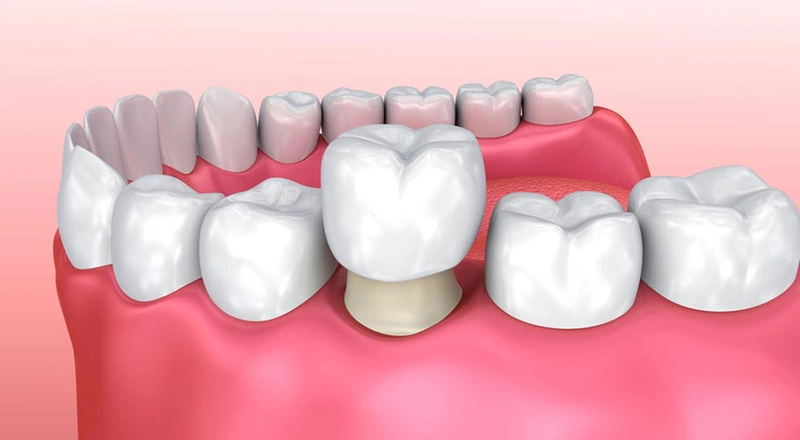 Người bị tụt lợi có nên bọc răng sứ hay không?
