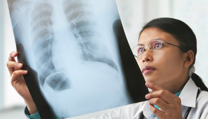 Giải đáp thắc mắc “Chụp X-quang có phát hiện ung thư phổi không?”