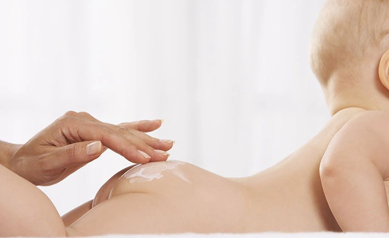 Kem trị hăm Sudocrem hỗ trợ điều trị bệnh chàm, rôm sẩy
