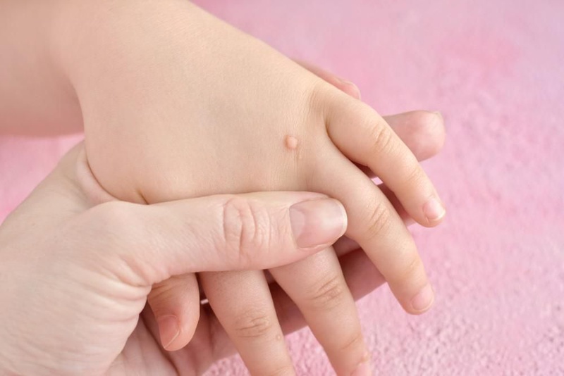 Mụn cóc có tự hết không là thắc mắc của nhiều người khi gặp phải tình trạng này