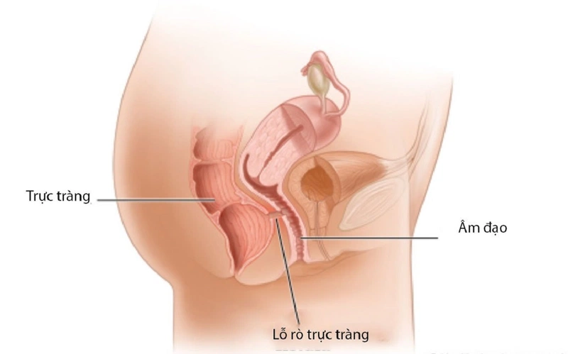 Giải đáp thắc mắc: Rách tầng sinh môn có tự lành không?3