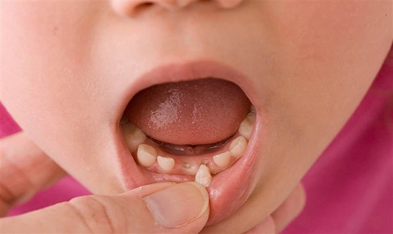 ​​​​​​​ Nên nhổ răng sữa cho trẻ từ 7 tuổi trở lên