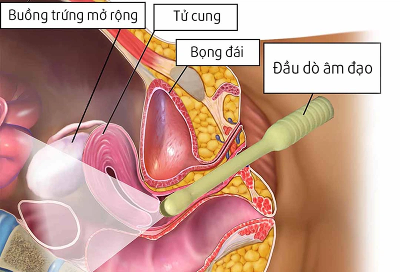 Giải đáp thắc mắc: Thai 12 tuần siêu âm bụng hay đầu dò? - Nhà thuốc FPT  Long Châu