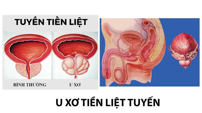 Giải đáp: U xơ tiền liệt tuyến có nên mổ không 1