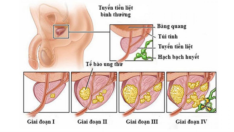 Giải đáp: Ung thư tuyến tiền liệt có chữa được không 1