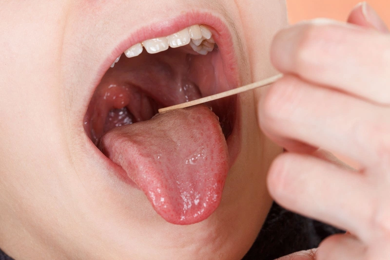 Giải đáp: Viêm họng hạt có gây hôi miệng không?