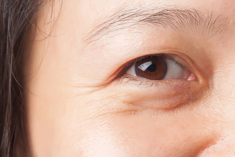 Giải đáp: Xuất hiện bọng mắt là dấu hiệu bệnh gì? Có nên thực hiện phẫu thuật mổ bọng mắt không 1