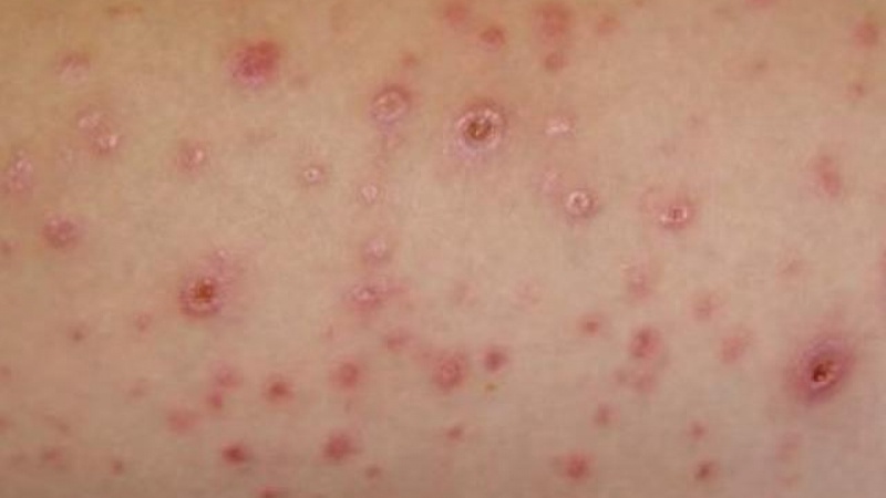 Các giai đoạn phát triển bệnh giang mai