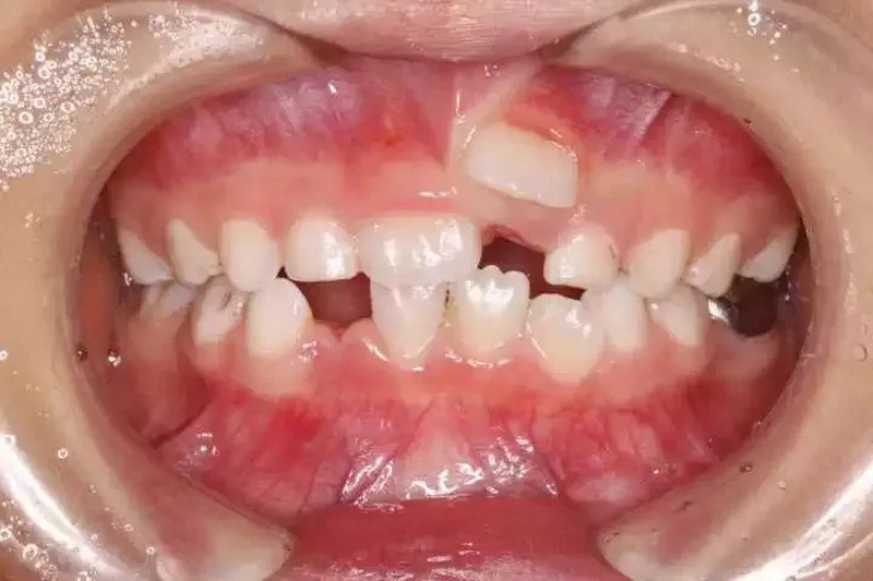Giải mã trường hợp răng sữa chưa rụng răng vĩnh viễn đã mọc ở trẻ