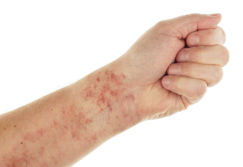 Giảm tiểu cầu trong điều trị ung thư1