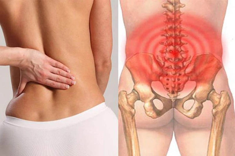 Giãn dây chằng thắt lưng có nguy hiểm không và phương pháp điều trị 3