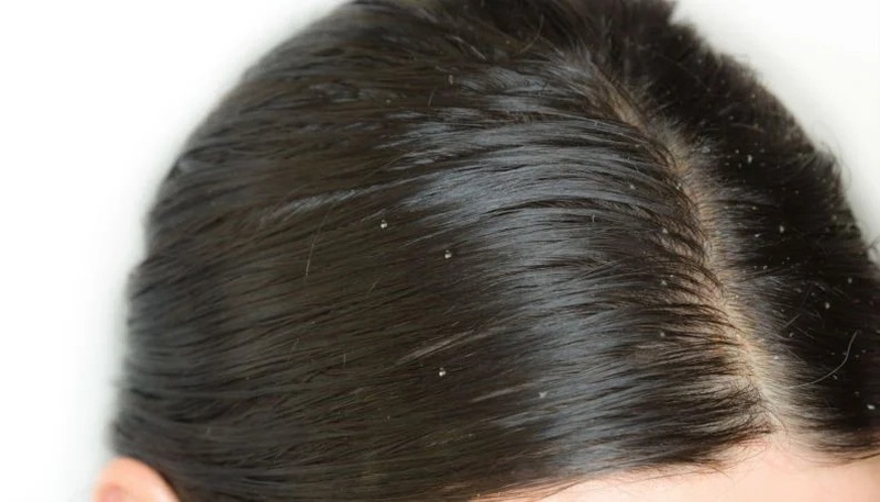 Giúp mẹ bỉm sữa xua tan nỗi lo tóc bị gàu sau sinh