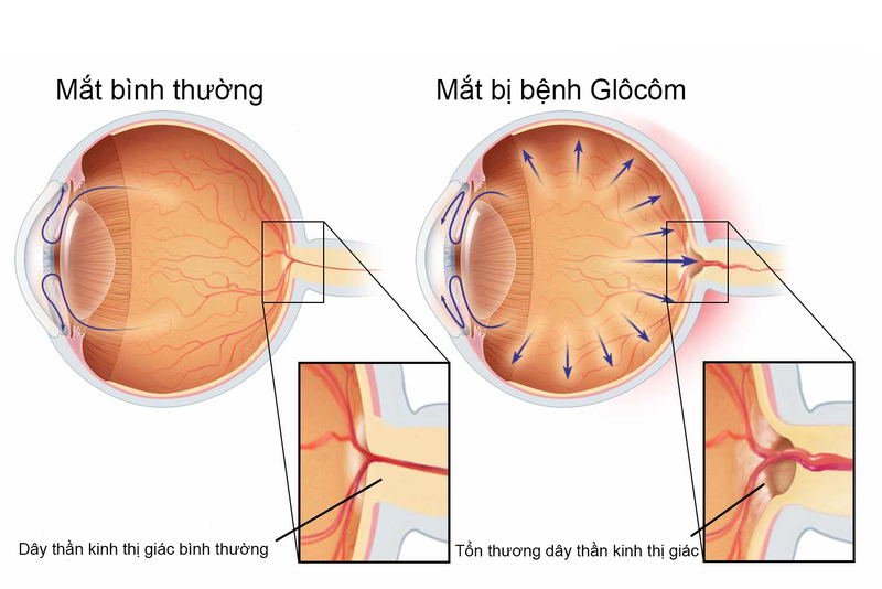 Glaucoma là bệnh gì? Có thể chữa trị không? Cách điều trị như thế nào? 1