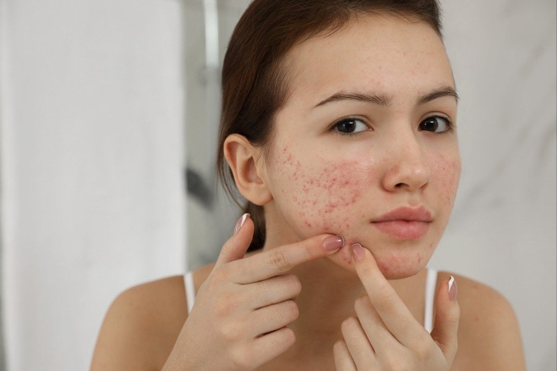 [Góc giải đáp] Có nên dùng các bài thuốc Đông y trị mụn không? 1