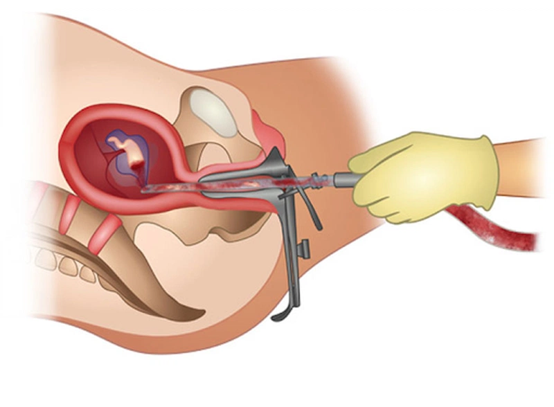 Góc giải đáp: Những dấu hiệu hút thai thành công là gì? 1