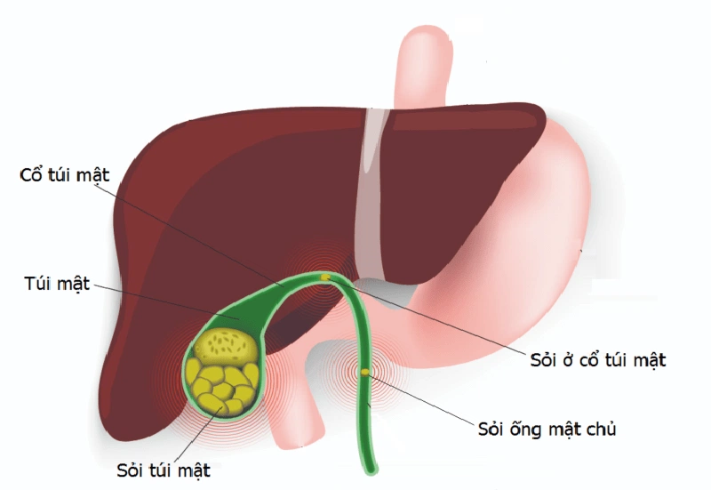 Sỏi mật có thể hình thành trong thời gian dài có chế độ ăn uống, sinh hoạt không khoa học