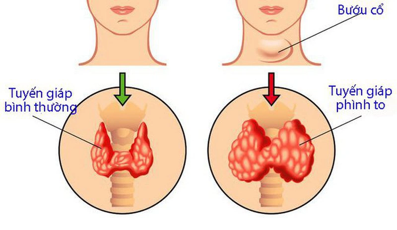 Góc giải đáp thắc mắc: Bướu cổ cần xét nghiệm gì? 1